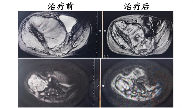 儿童肿瘤之王如何实现精准治疗？河北一洲肿瘤医院专家分享神经母细胞瘤质子治疗实践
